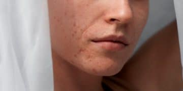 Acne-Prone Skin? A Targeted Skincare Routine for Clear Skin - Cover Image